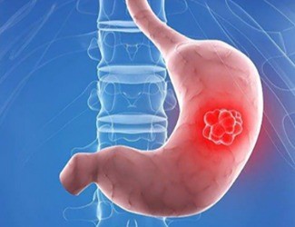 你知道嗎？從慢性胃炎到胃癌，只有四步！